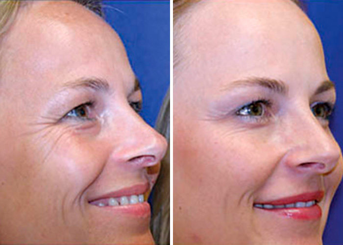Side-by-side comparison of identical twins smiling, showing dramatic differences, with one twin using Botox. Side-by-side comparison of identical twins smiling, showing dramatic differences, with one twin using Botox.