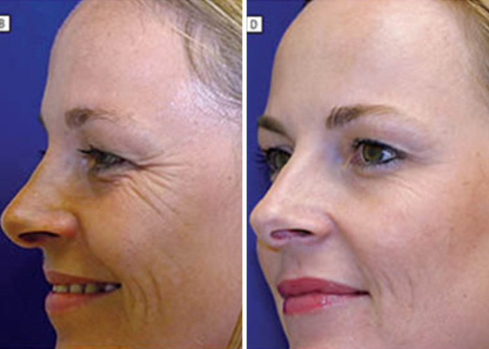 Dramatic differences in identical twins after Botox. One twin has noticeable wrinkles around her eyes. Dramatic differences in identical twins after Botox. One twin has noticeable wrinkles around her eyes.