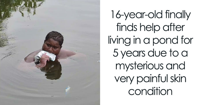 16YO Lives In A Pond To Escape Burning Sensation, Doctors Baffled By A Condition Nobody Can Explain