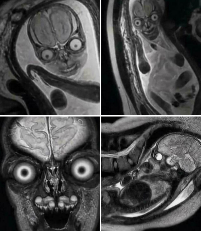 Fetuses Look Like Aliens