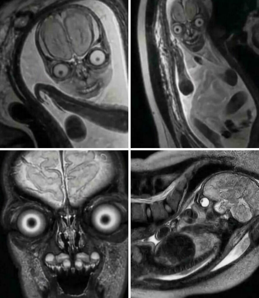 Four MRI scans of a fetus showing disturbing facial features, explaining why ultrasounds are preferred, highlighting strange things on Earth.