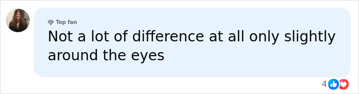 A top fan comment noting only a slight difference around the eyes of identical twins after 20 years of Botox, revealing dramatic differences. A top fan comment noting only a slight difference around the eyes of identical twins after 20 years of Botox, revealing dramatic differences.