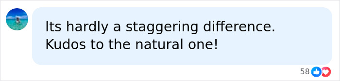 A comment on the dramatic differences between identical twins, one using Botox, praising the natural look. A comment on the dramatic differences between identical twins, one using Botox, praising the natural look.