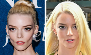 After Anya Taylor-Joy Seemingly Went Back On Her Buccal Fat Removal, Expert Weighs In On Reversal Procedure