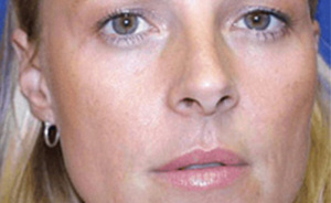 Identical Twins Show Dramatic Differences After One Uses Botox For 20 Years And The Other Doesn't