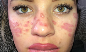 Reality Star Launches Fake Freckle Brand After Attempt At Tattooing Her Own Face For Viral Trend Left Her Scarred