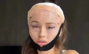 How Young Is Too Young To Get A Korean Facelift? Netizens Criticize Influencer's Decision After Recovery Posts