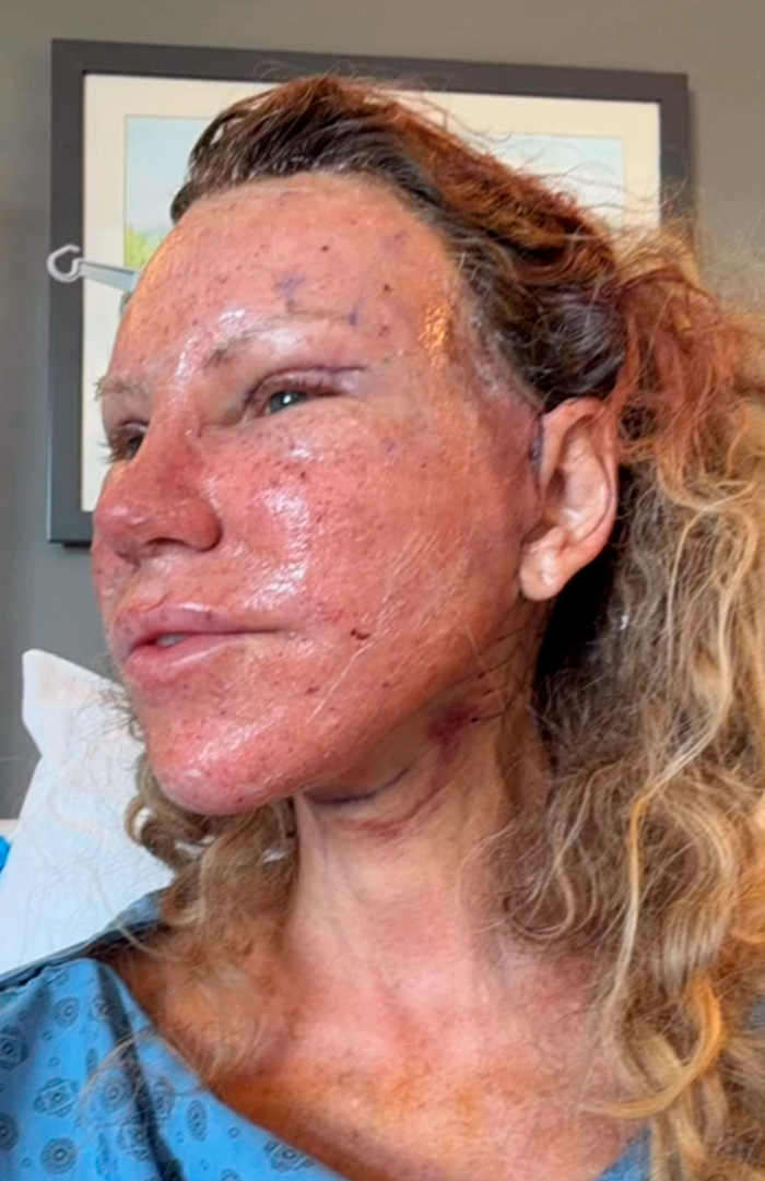 51-Year-Old Woman Goes Viral After She Breaks Down The Biggest Surprises Of Her Facelift 51-Year-Old Woman Goes Viral After She Breaks Down The Biggest Surprises Of Her Facelift