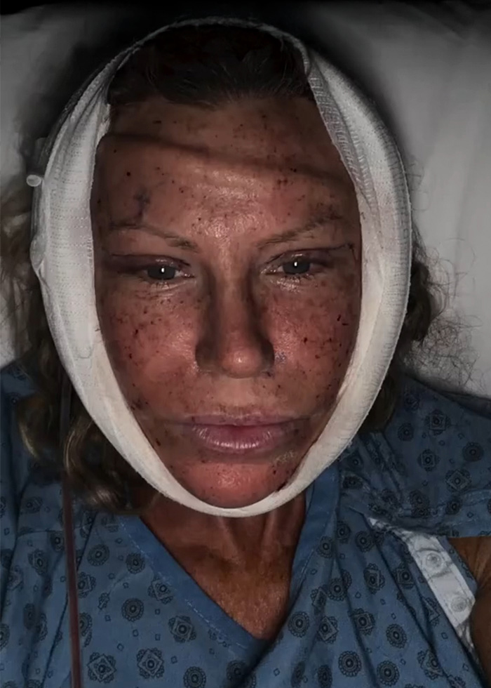 51-Year-Old Woman Goes Viral After She Breaks Down The Biggest Surprises Of Her Facelift 51-Year-Old Woman Goes Viral After She Breaks Down The Biggest Surprises Of Her Facelift