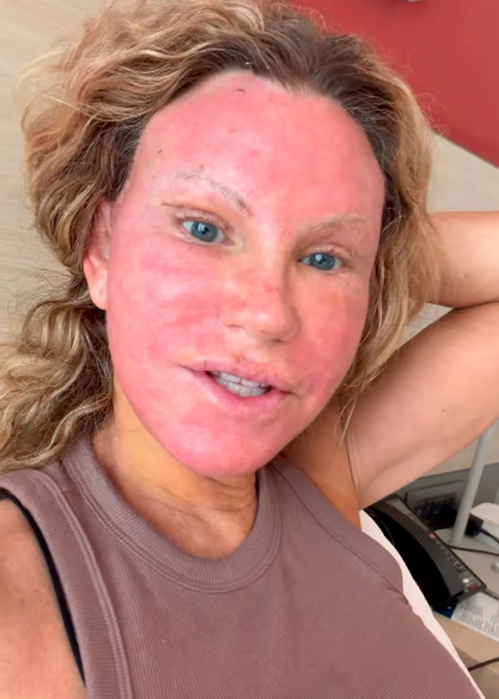 51-Year-Old Woman Goes Viral After She Breaks Down The Biggest Surprises Of Her Facelift 51-Year-Old Woman Goes Viral After She Breaks Down The Biggest Surprises Of Her Facelift
