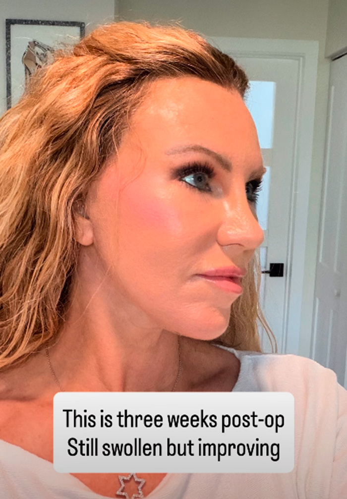 51-Year-Old Woman Goes Viral After She Breaks Down The Biggest Surprises Of Her Facelift 51-Year-Old Woman Goes Viral After She Breaks Down The Biggest Surprises Of Her Facelift