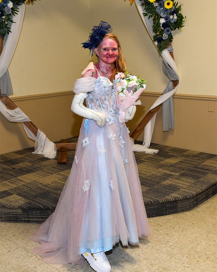 A woman with a rare skin condition in a beautiful gown, demonstrating her strength despite extreme measures to protect herself. A woman with a rare skin condition in a beautiful gown, demonstrating her strength despite extreme measures to protect herself.