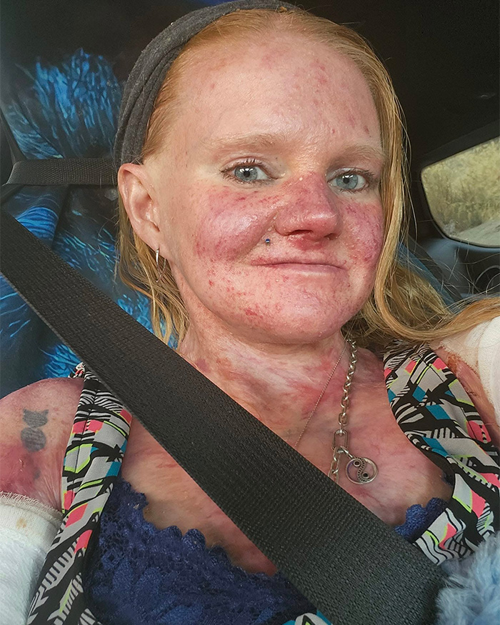A close-up of a woman with a rare skin condition in a car, highlighting her extreme measures to protect herself. A close-up of a woman with a rare skin condition in a car, highlighting her extreme measures to protect herself.