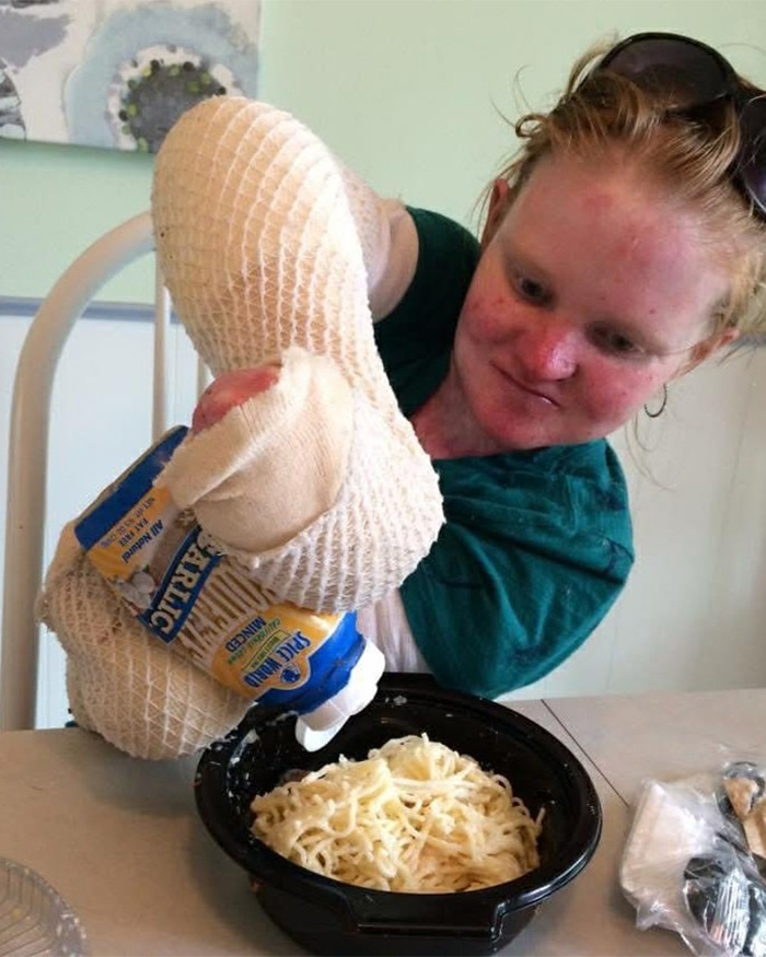 A woman with a rare skin condition, wearing protective mitts, squeezes sauce onto pasta, detailing extreme measures. A woman with a rare skin condition, wearing protective mitts, squeezes sauce onto pasta, detailing extreme measures.