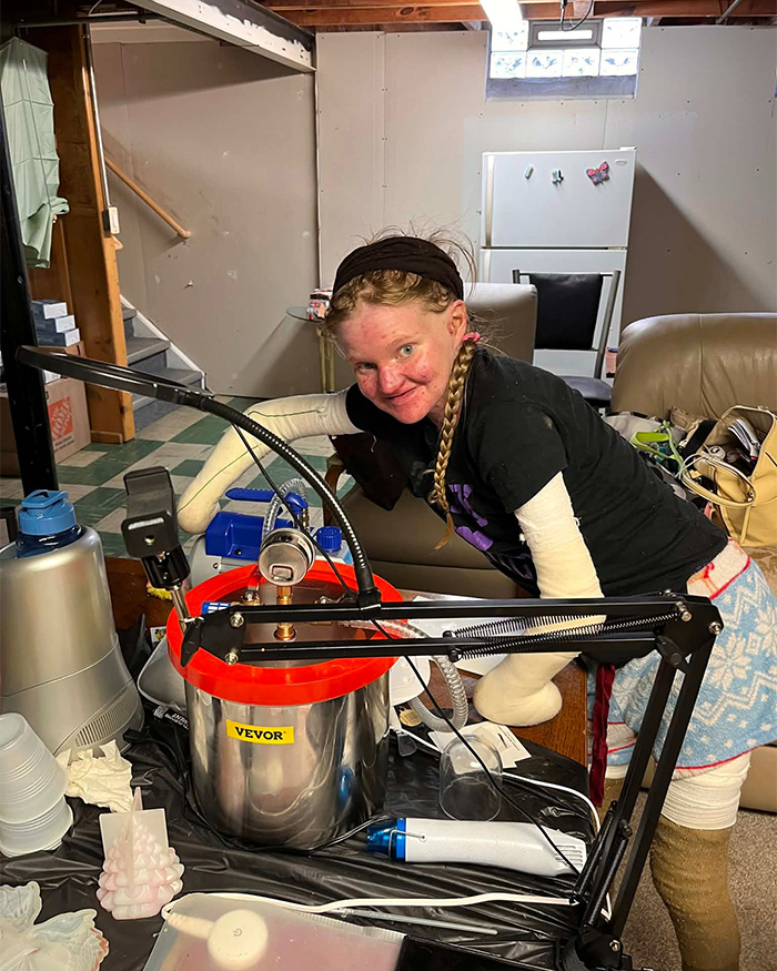 A woman with a rare skin condition stands beside medical equipment, detailing extreme measures for protection. A woman with a rare skin condition stands beside medical equipment, detailing extreme measures for protection.