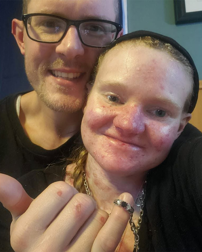 A woman with a rare skin condition, showing her face and hand, smiles with a man, detailing extreme measures. A woman with a rare skin condition, showing her face and hand, smiles with a man, detailing extreme measures.