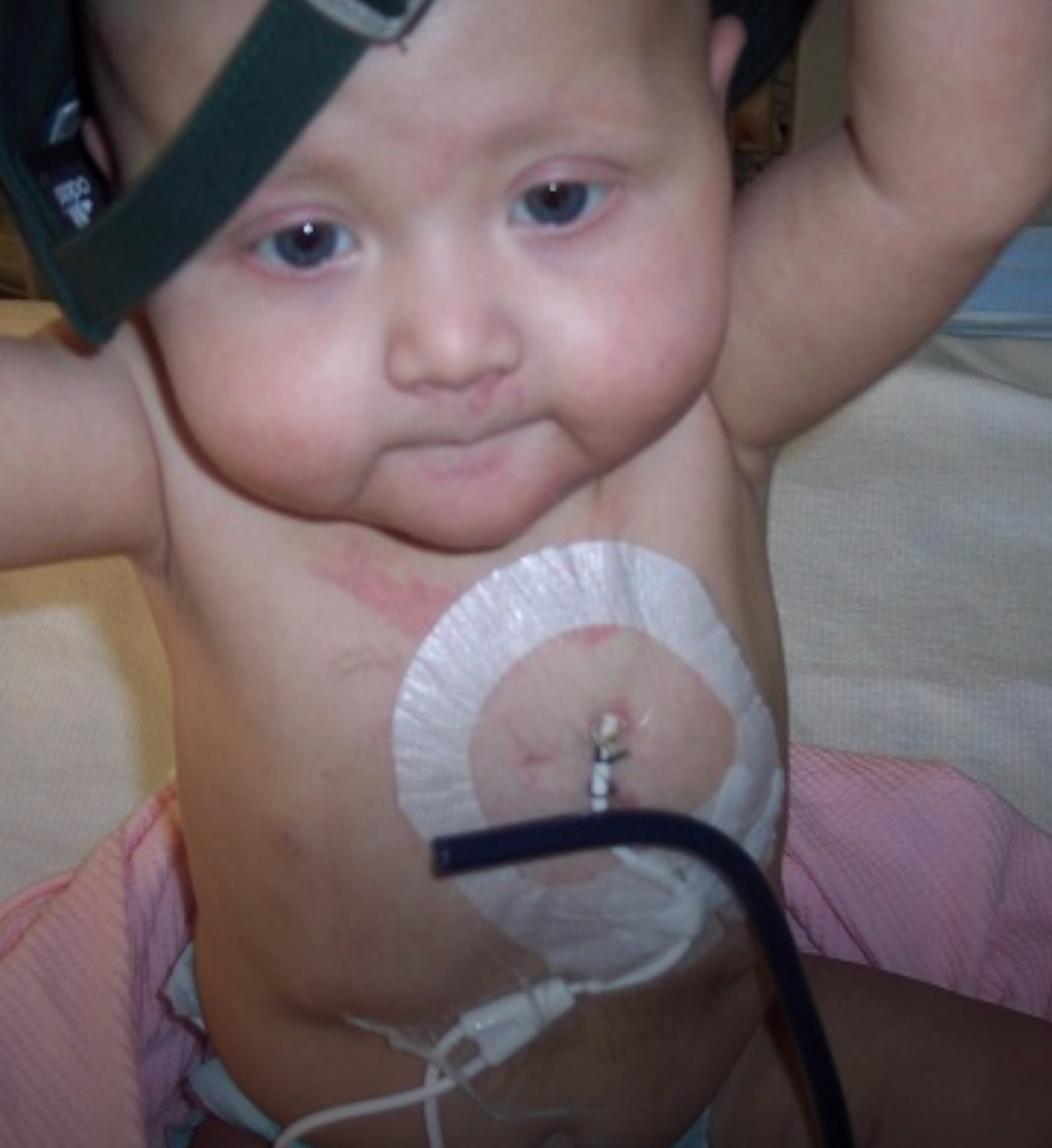 Baby with medical port on chest connected to leukemia treatment Baby with medical port on chest connected to leukemia treatment