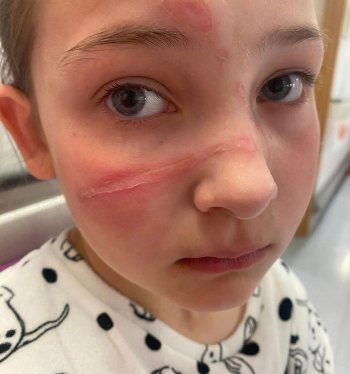 A child's face with visible injuries and red marks, showing serious injuries from popular squishy toys. A child's face with visible injuries and red marks, showing serious injuries from popular squishy toys.