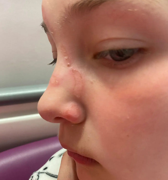 Close-up of a child's face in profile, showing serious injuries on the nose and cheek, caused by popular squishy toys. Close-up of a child's face in profile, showing serious injuries on the nose and cheek, caused by popular squishy toys.