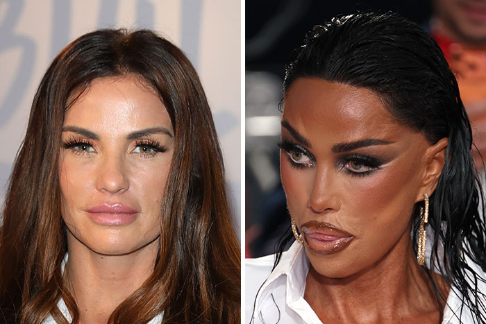 Katie Price before and after corrective surgery showing a dramatic change in appearance. Katie Price before and after corrective surgery showing a dramatic change in appearance.