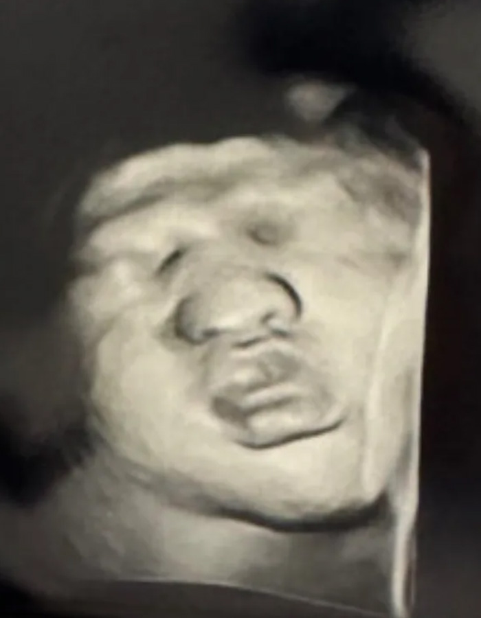 An ultrasound scan image showing a close-up of a baby's face. An ultrasound scan image showing a close-up of a baby's face.