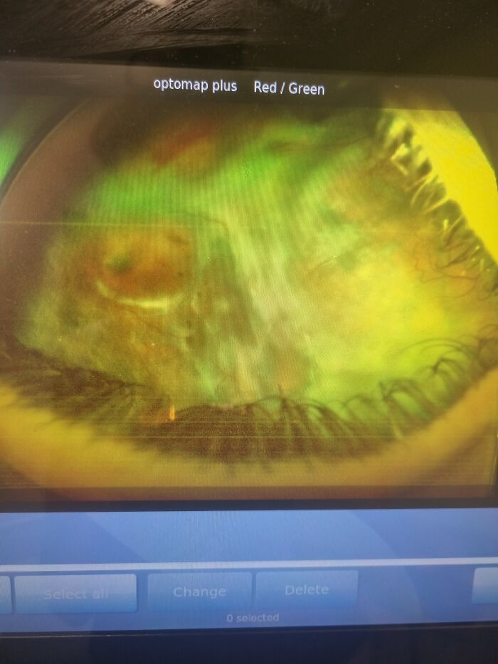 An optomap retinal scan image displaying blurry vision diagnostic details of a tumor
