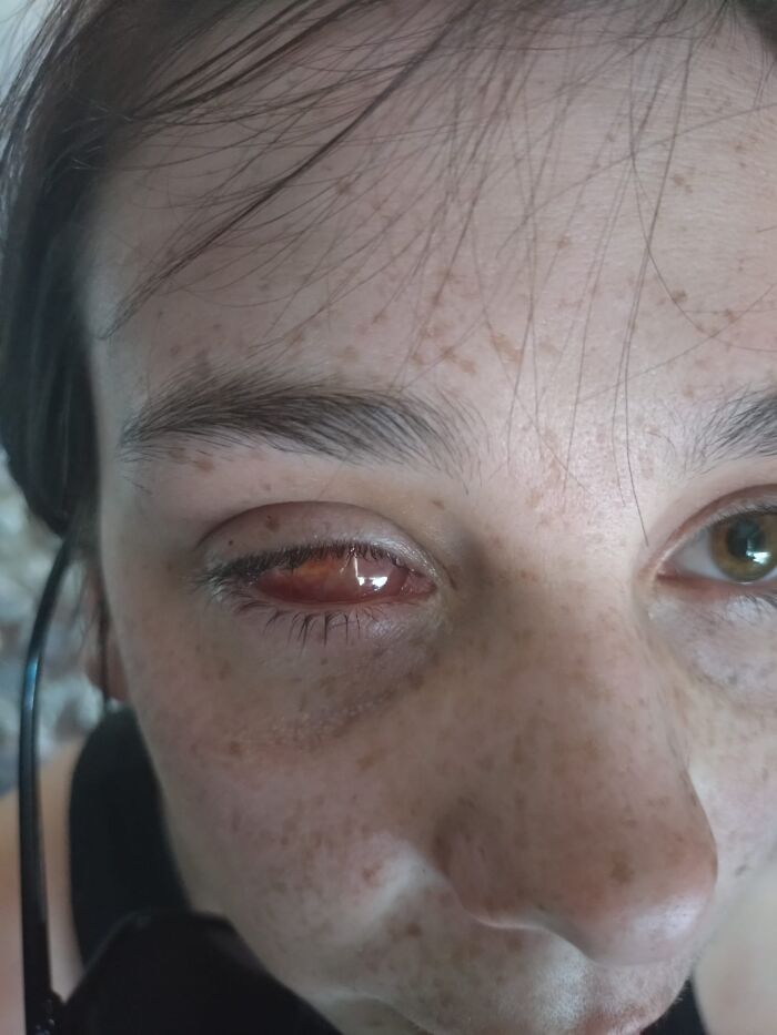 Close-up of a woman experiencing severe eye redness and blurry vision before diagnosis