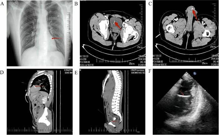 Medical scans showing foreign bodies in chest, pelvis, bladder areas with markers