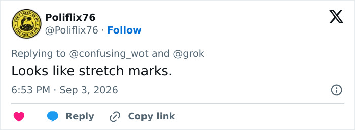 A tweet from Poliflix76 suggesting the mysterious marks on Sydney Sweeney's rib and stomach are stretch marks. A tweet from Poliflix76 suggesting the mysterious marks on Sydney Sweeney's rib and stomach are stretch marks.