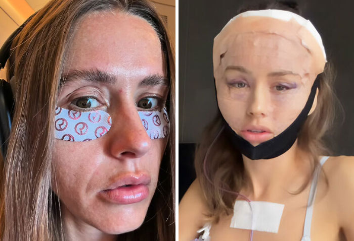 Two images of women with eye patches and facial bandages, highlighting Western beauty standards pressure. Two images of women with eye patches and facial bandages, highlighting Western beauty standards pressure.