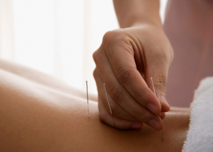 Close-up of acupuncture needles inserted in patient's back