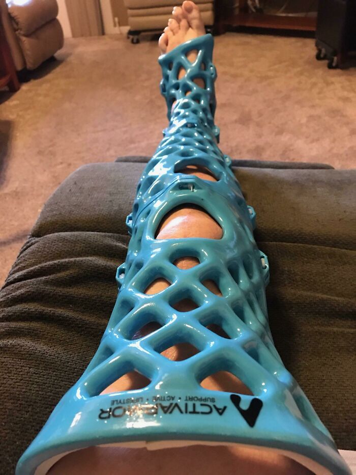 A person with a blue 3D printed leg brace, showcasing brilliant uses for 3D printers.