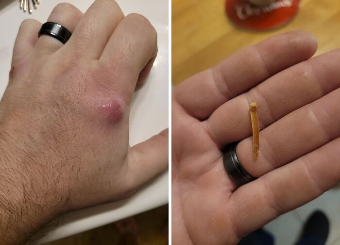 A person's hand with a swollen bump and the splinter removed, among bizarre things.