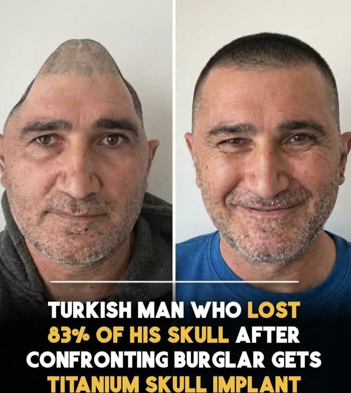 Uplifting posts: Turkish man before and after titanium skull implant, smiling with a restored head.
