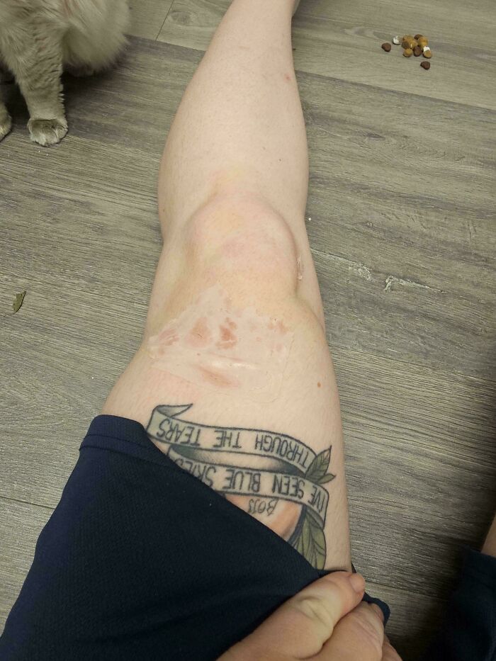 Mildly interesting picture of a person's leg with a unique tattoo, revealing a recent injury or skin treatment.