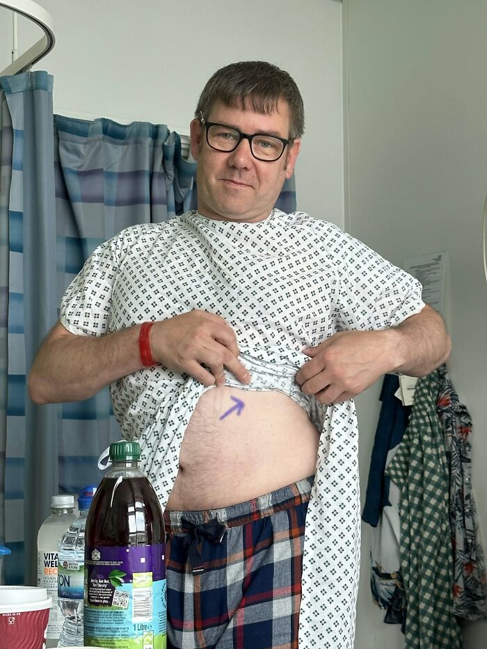 A man in a hospital gown lifts his shirt to show a marked abdomen. Proof of finding the right man.