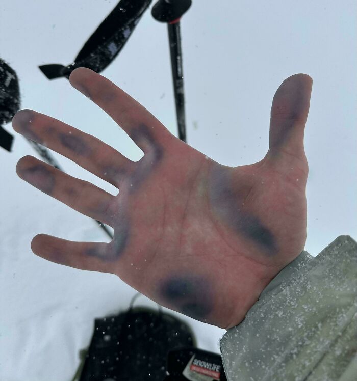 An open palm with discolored purple patches, a rare and unexpected body quirk.