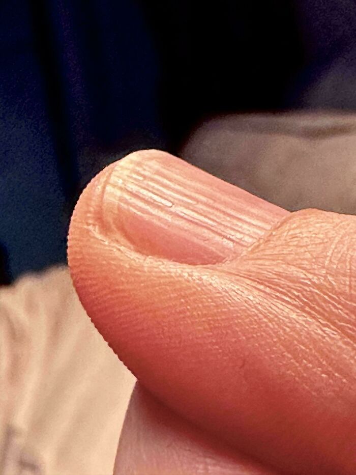 A detailed view of a finger, highlighting a unique body quirk with ridges.