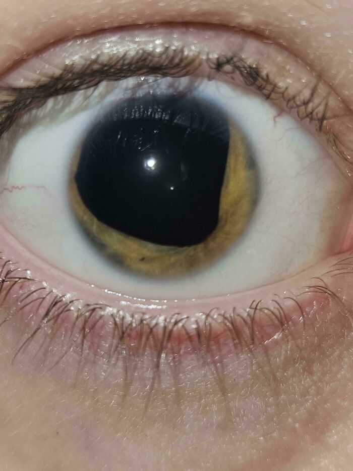 A close-up of an eye with a distinctively shaped pupil, revealing a rare body quirk.
