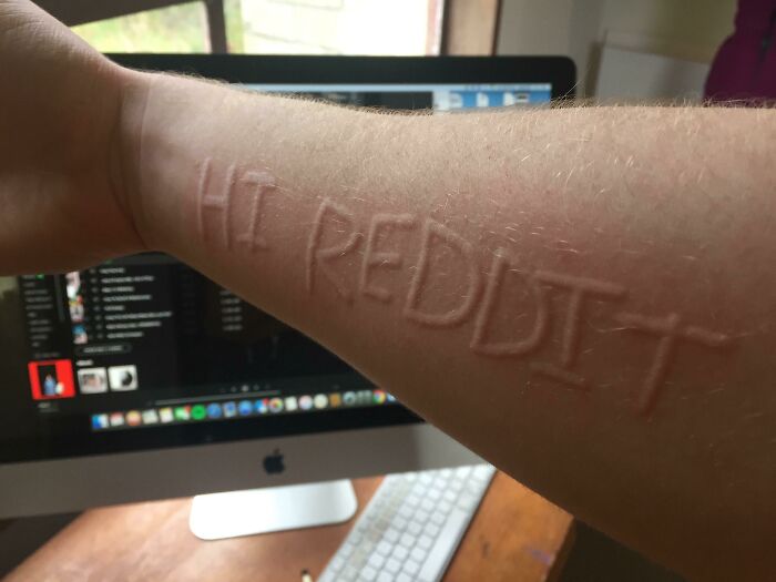 An arm with raised welts forming text, an unexpected body quirk.