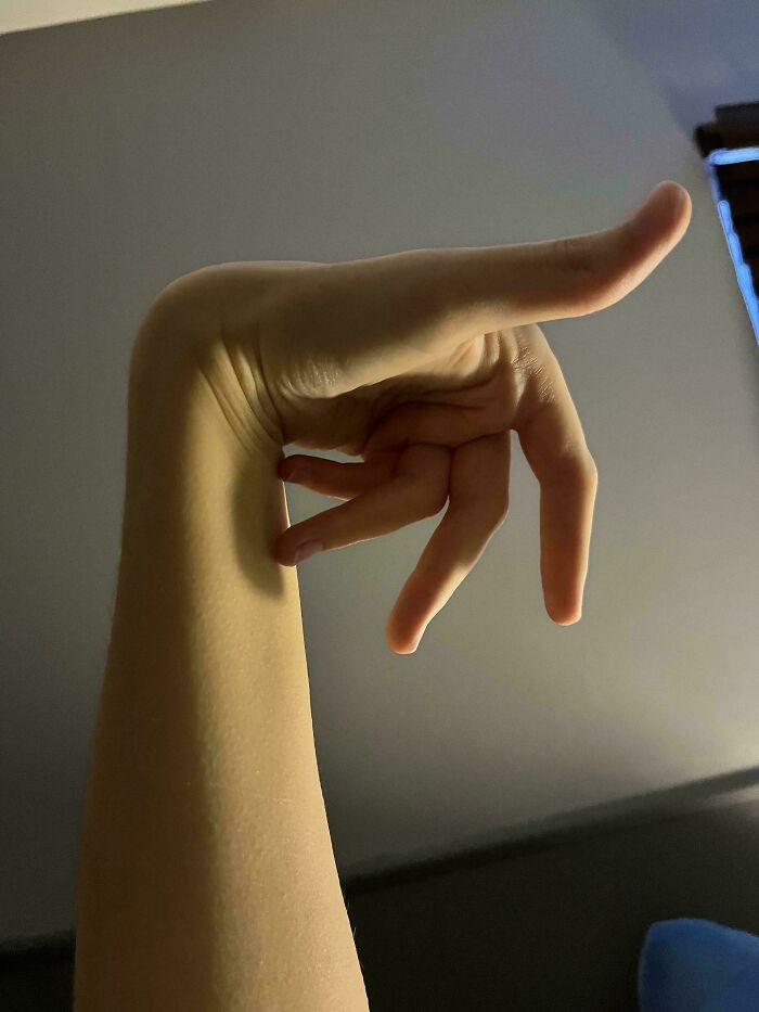 A person showcasing a hand with unusual flexibility, demonstrating rare body quirks.