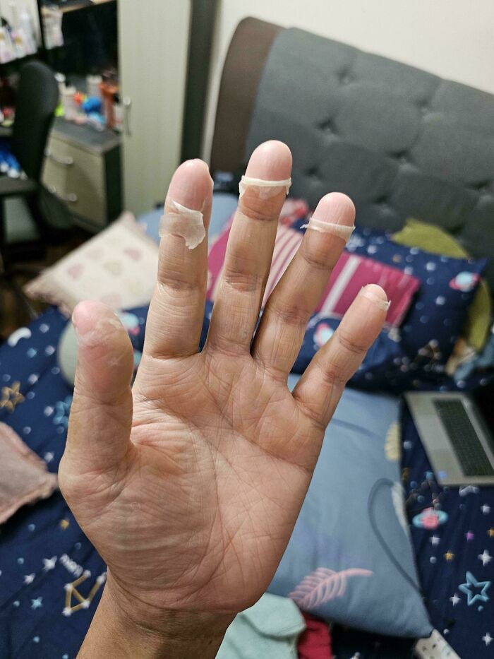 A hand showing peeling skin, a rare body quirk or condition, fascinating people with unique body quirks.