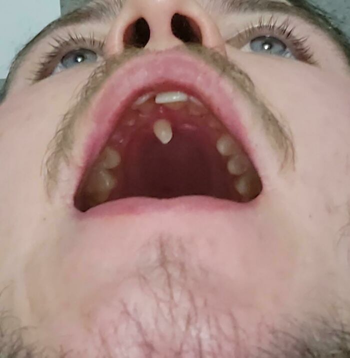 A person with a rare body quirk, a natal tooth in the palate, an unexpected and fascinating body quirk.