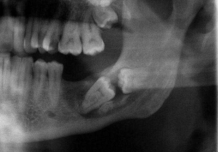 An X-ray revealing a rare body quirk of impacted wisdom teeth, a fascinating body quirk.