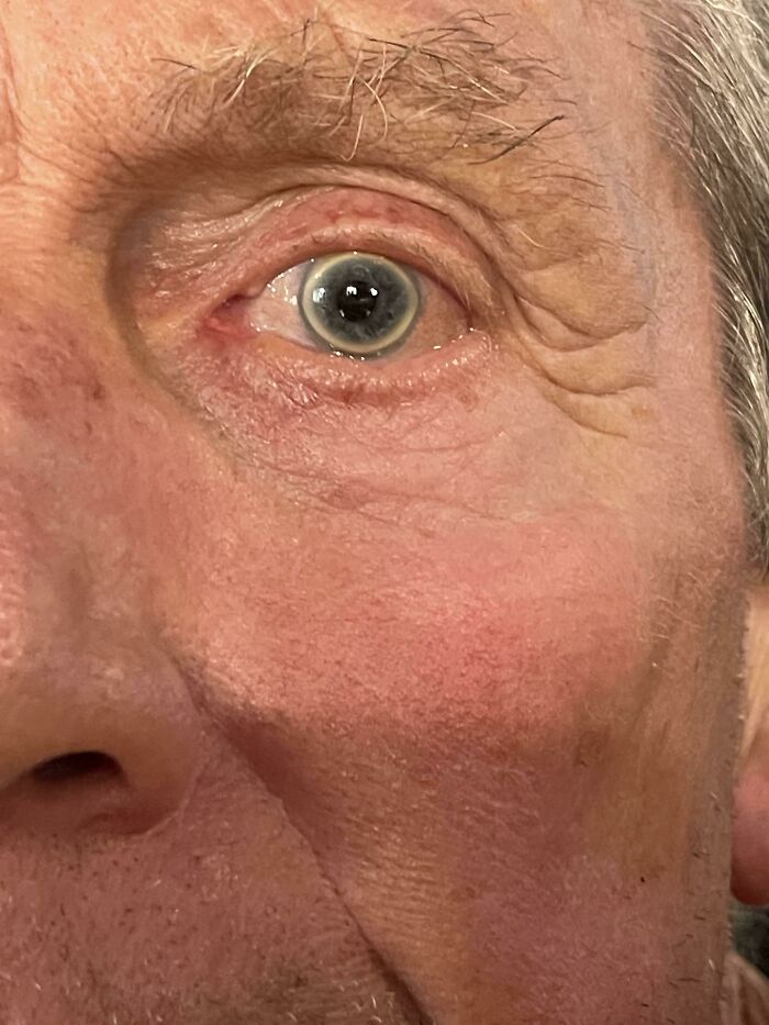 Close-up of an eye with a rare body quirk: a dark, irregularly shaped pupil in a blue eye.