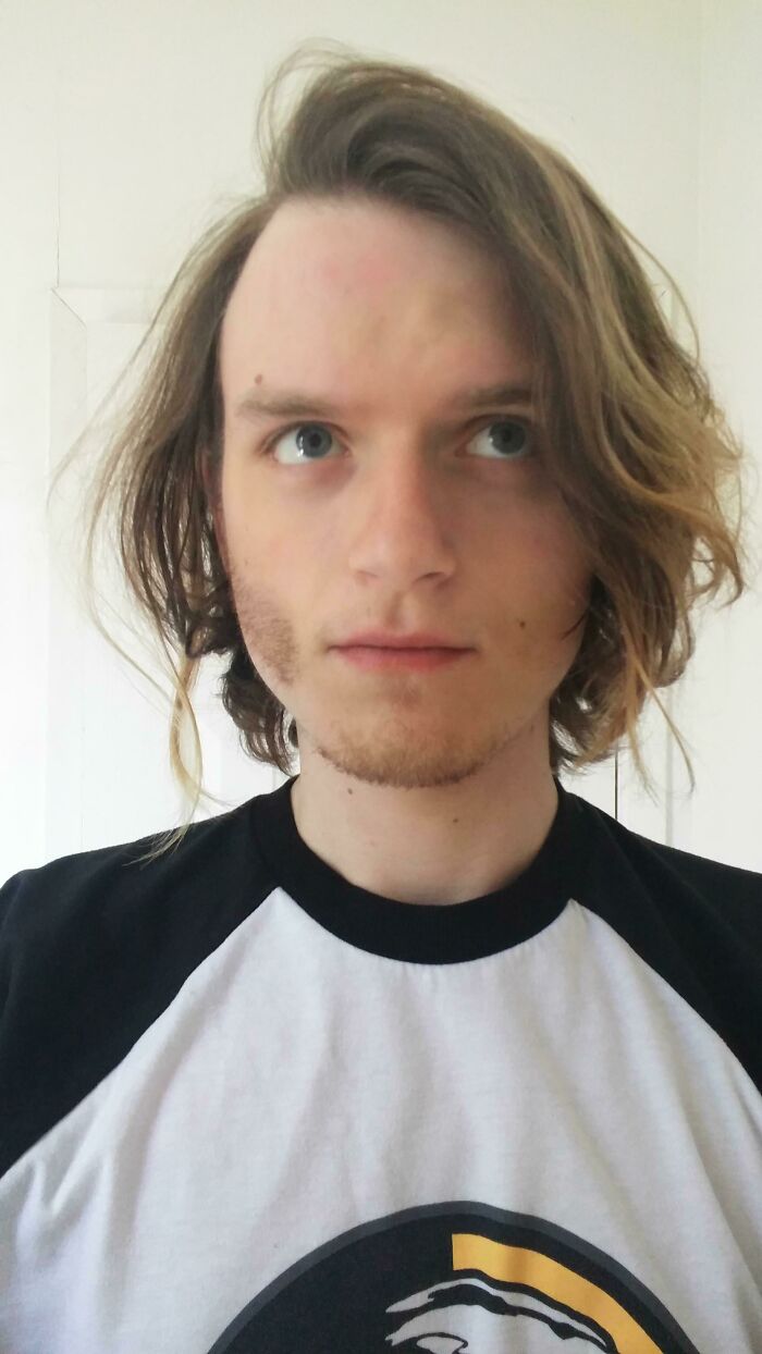 A young man with long hair displays a rare body quirk: a patch of darker skin and hair on one side of his face.