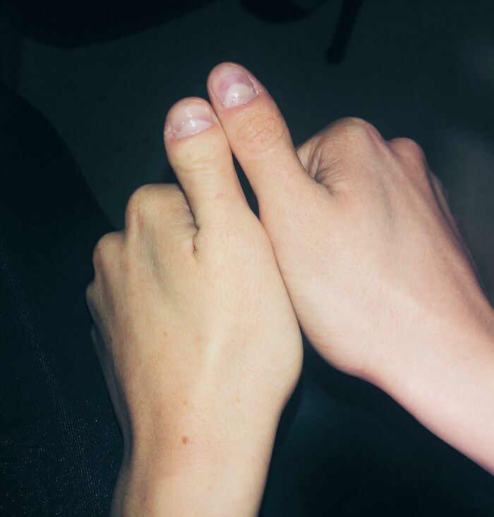 Two thumbs with unique shapes, illustrating fascinating body quirks.