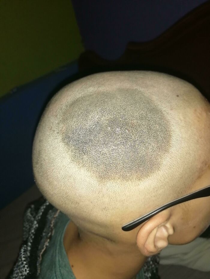A shaved head with a distinct circular pattern of darker hair, highlighting body quirks.