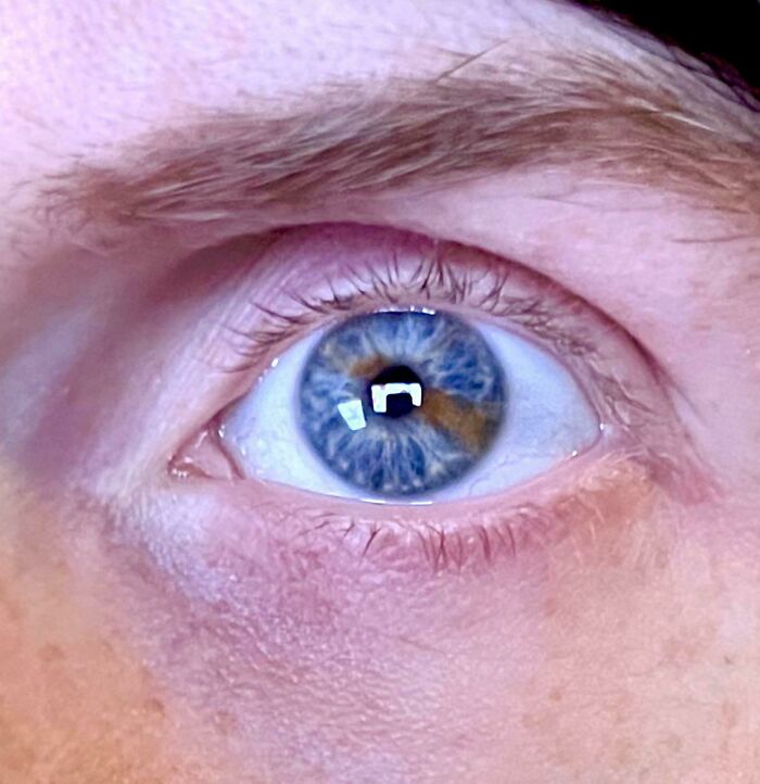 A close-up of an eye with partial heterochromia, a fascinating body quirk.
