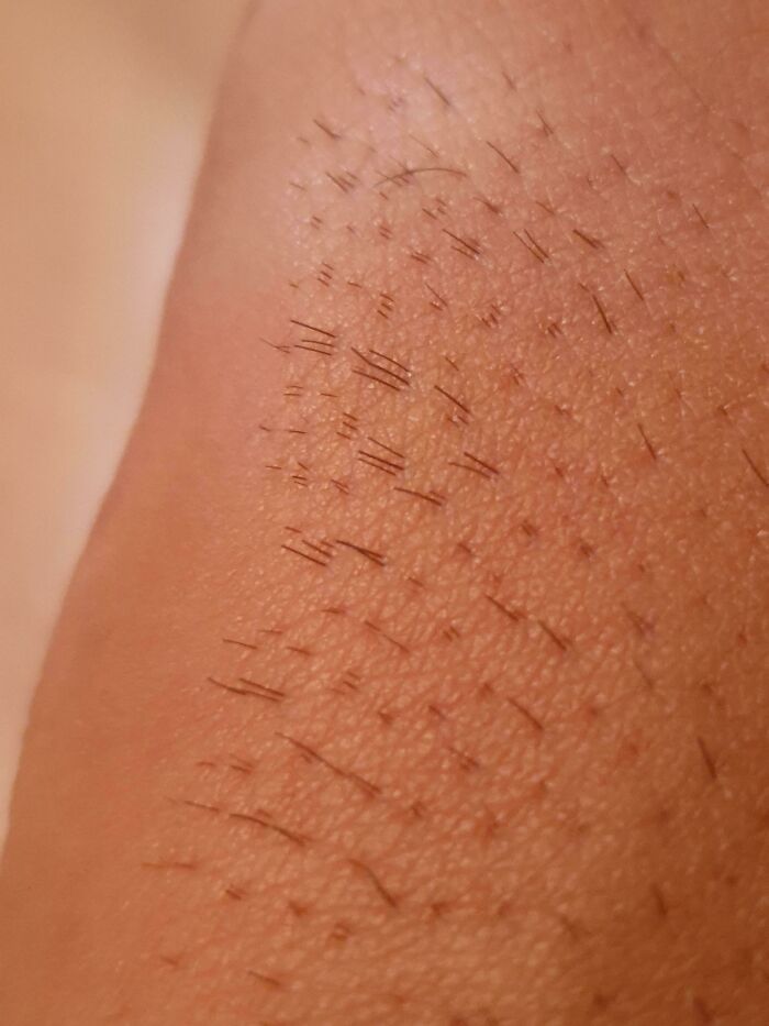A close-up of skin with short, dark hairs growing in a distinct, unusual pattern, a rare body quirk.